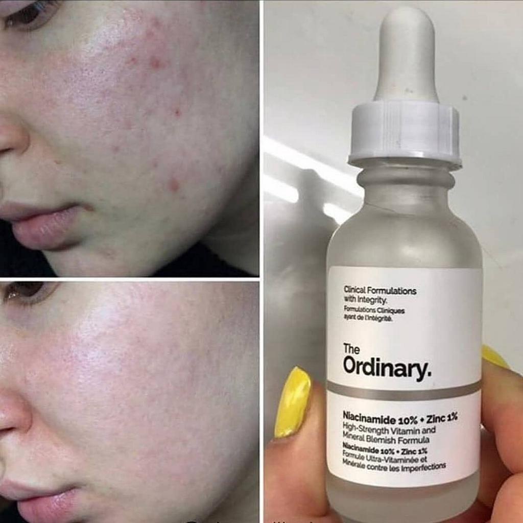 Serum Niacinamide 10% + Zinc 1% của The Ordinary - serum Nia 30ML