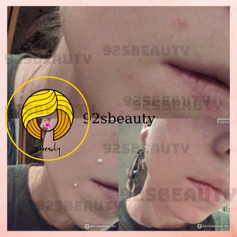 Dung dịch kẽm bôi mụn Propellers giúp giảm mụn hiệu quả | BigBuy360 - bigbuy360.vn