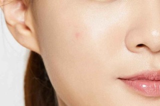 MIẾNG DÁN MỤN COSRX HÀN QUỐC