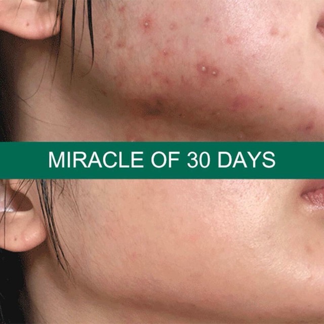 Serum ngăn ngừa Mụn Some By Mi AHA BHA PHA 30 Days Miracle