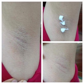 TRIỆT LÔNG NANO GEL