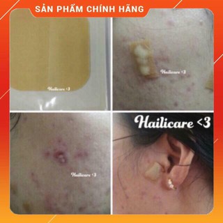 [SIÊU SALE] Miếng dán hút mụn mủ Duoderm Extra Thin (khỏi lo mụn mủ)
