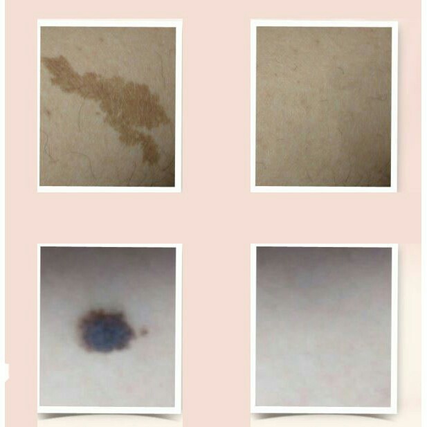 Kem che sẹo 2 mầu Demacare | BigBuy360 - bigbuy360.vn