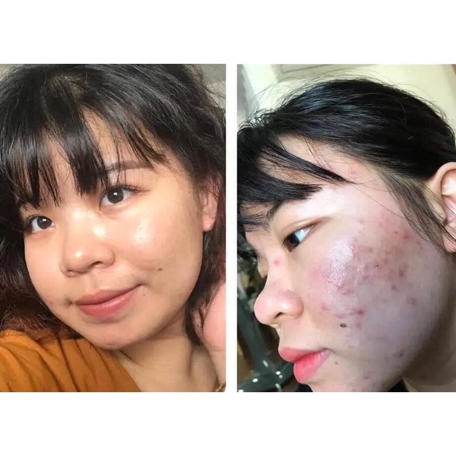 Gel giảm mụn Differin Acne Treatment Gel Adapalene Gel 0.1%