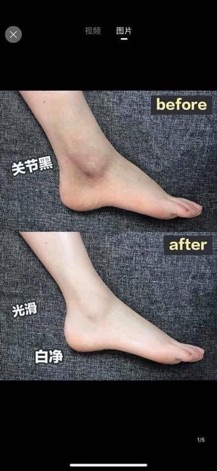 Kem trị thâm nách và đầu gối