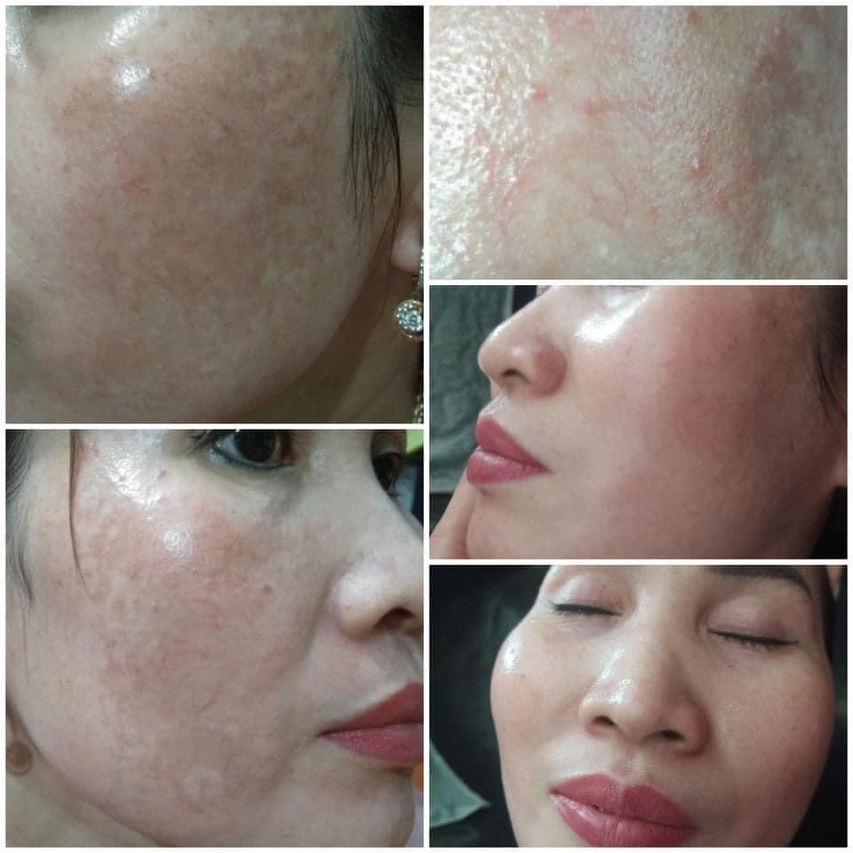Kem Giảm Nám Tàn Nhang Dưỡng Trắng Da Mờ Thâm Sạm Chống Nắng Queenieskin Hiệu Quả Sau 10 Ngày