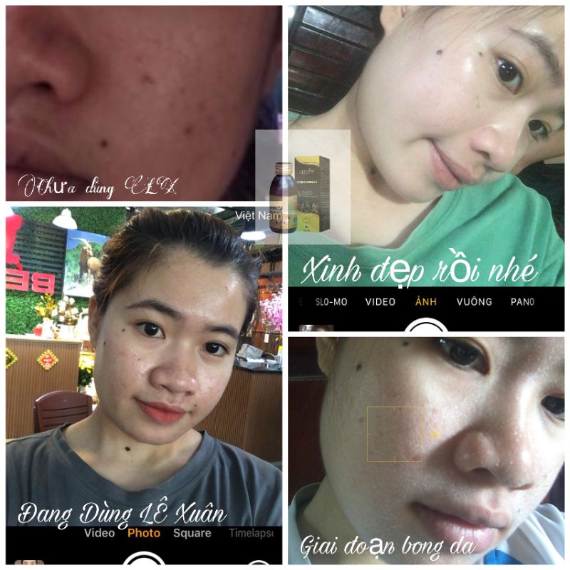 Ngừa mụn Lê Xuân🍀thảo dược đông y lê xuân🍀loại bỏ mụn trứng cá, mụn ẩn, mụn viêm,… | BigBuy360 - bigbuy360.vn