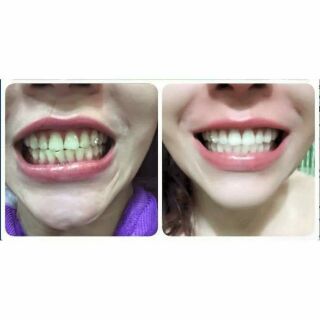 Bột trắng răng