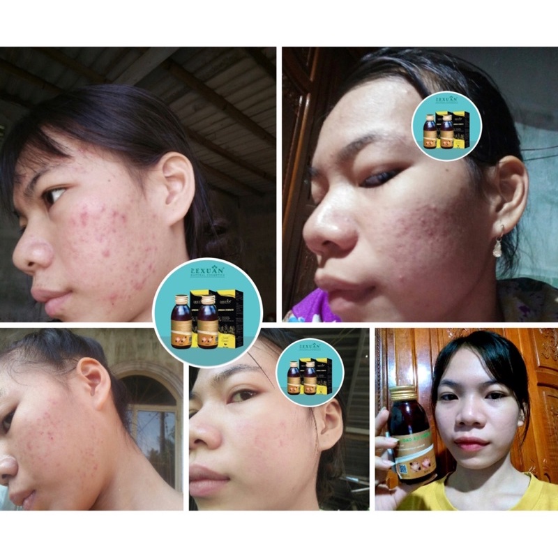 Ngừa mụn Lê Xuân🍀thảo dược đông y lê xuân🍀loại bỏ mụn trứng cá, mụn ẩn, mụn viêm,… | BigBuy360 - bigbuy360.vn