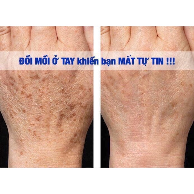 Kem trị đồi mồi tay