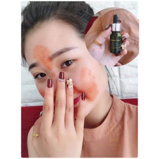 Serum chăm sóc da Mụn (Serum KST) Dr.Antinn | Hathor Beauty (Kim Thiên Hoa) | BigBuy360 - bigbuy360.vn