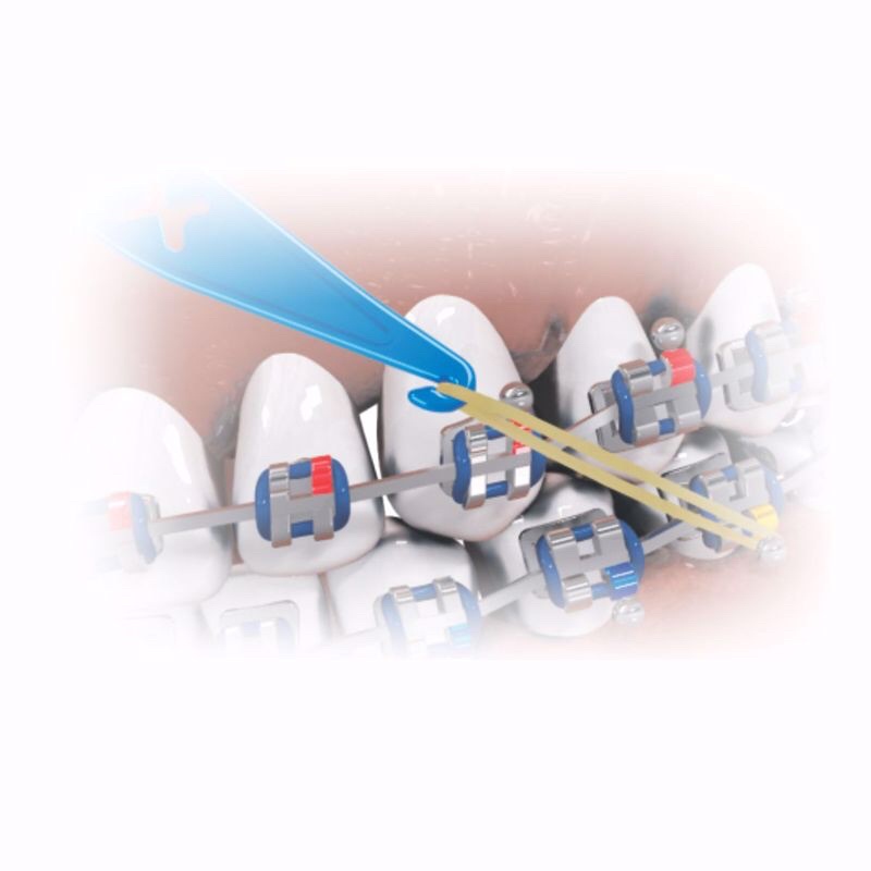 Cây móc chun kéo liên hàm