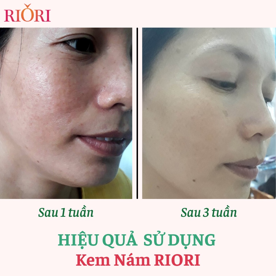 Kem Ngừa Nám RIORI HANA MELASMA COLLAGEN CREAM 30g (Mới)