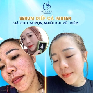 Combo Toàn Diện Cho Da Hết Mụn, Thâm - Combo Diếp Cá IGREEN