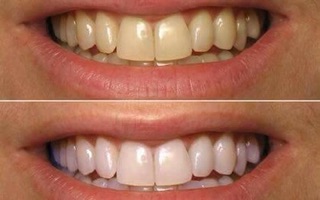 than hoạt tính trắng răng #tanoshi