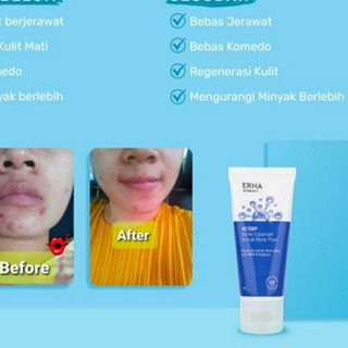 (Hàng Mới Về) Xà Phòng Erha21 Trị Mụn Chăm Sóc Da Mặt