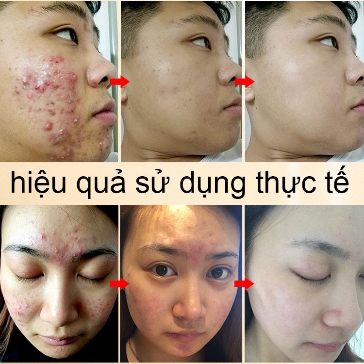 Kem Giảm Mụn Kem dưỡng giảm mụn mặt nạ giảm mụn kem trị thâm mụn mụn tàn nhang làm trắng dưỡng ẩm 30g