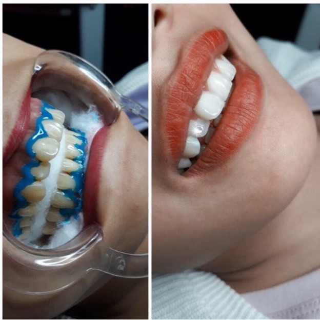 Thuốc Tẩy Trắng Răng Dr Whiten Only 30 minuture