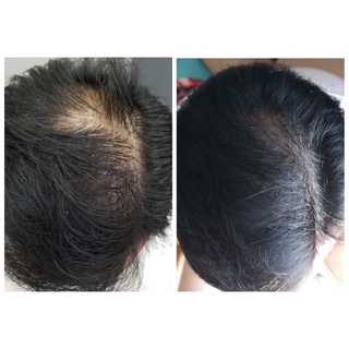 XỊT MỌC TÓC VÀ CHỐNG RỤNG COMPLIMENT NGA