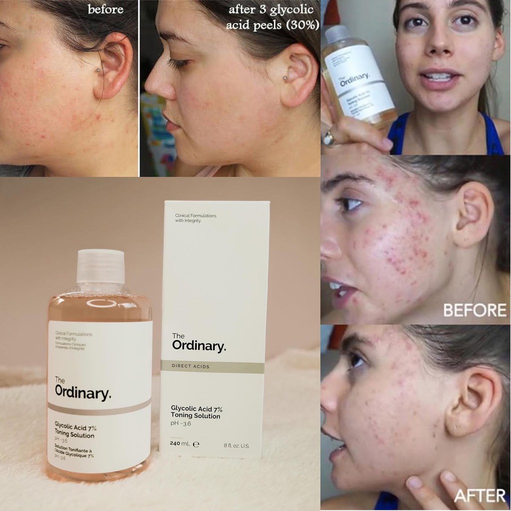 Toner Tẩy Da Chết Glycolic Acid 7% Toning Solution The Ordinary | BigBuy360 - bigbuy360.vn