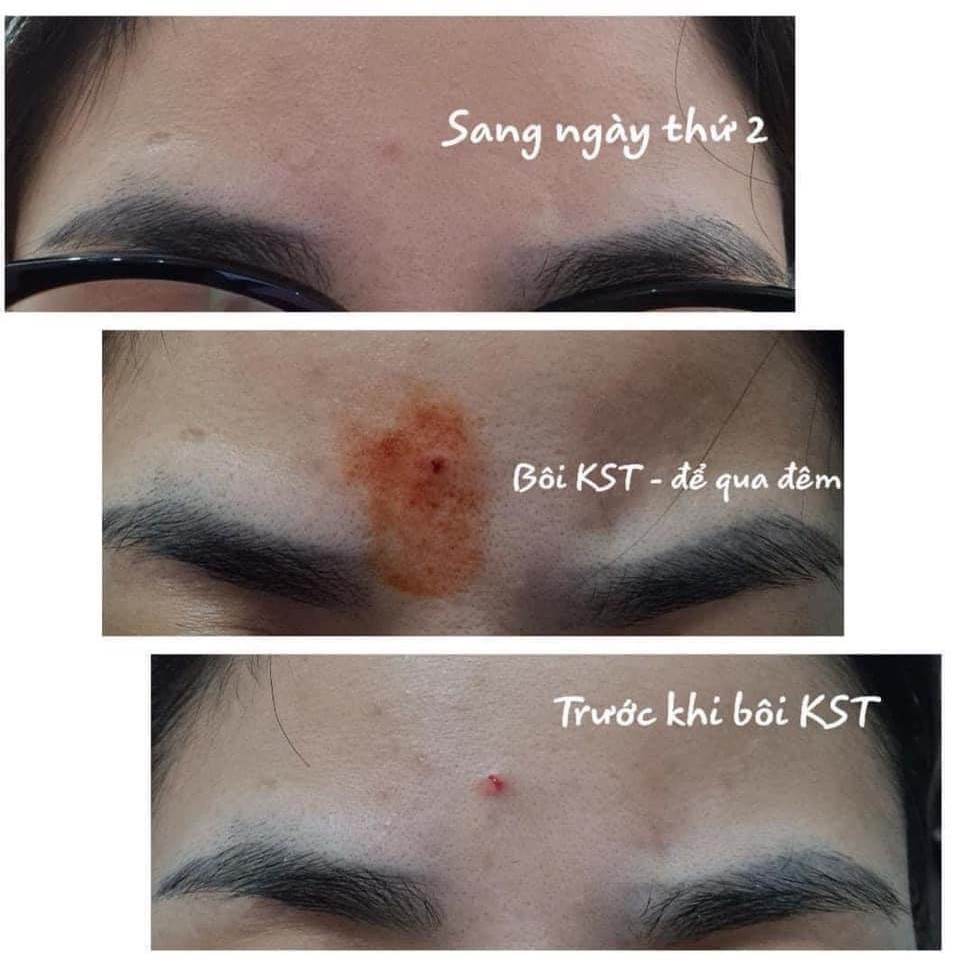 Serum chăm sóc da Mụn (Serum KST) Dr.Antinn | Hathor Beauty (Kim Thiên Hoa)