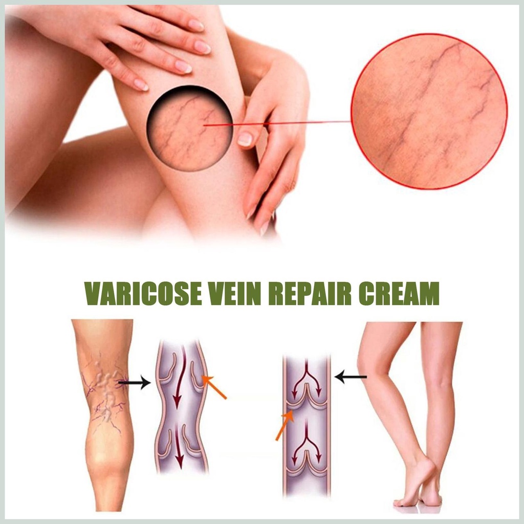 Kem Suy Giãn Tĩnh Mạch Perfect Skin 50g - Kem Varicose Vein Repair Cream Restore Thảo Dược Cải Thiện Tĩnh Mạch