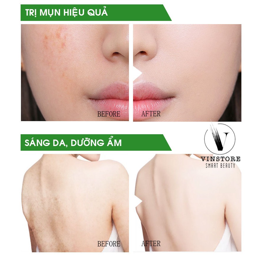 Xà phòng sạch mụn lưng, mụn cám tinh chất trà xanh matcha Farims, kháng khuẩn, sạch mụn hiệu quả, dưỡng ẩm chăm sóc da | BigBuy360 - bigbuy360.vn