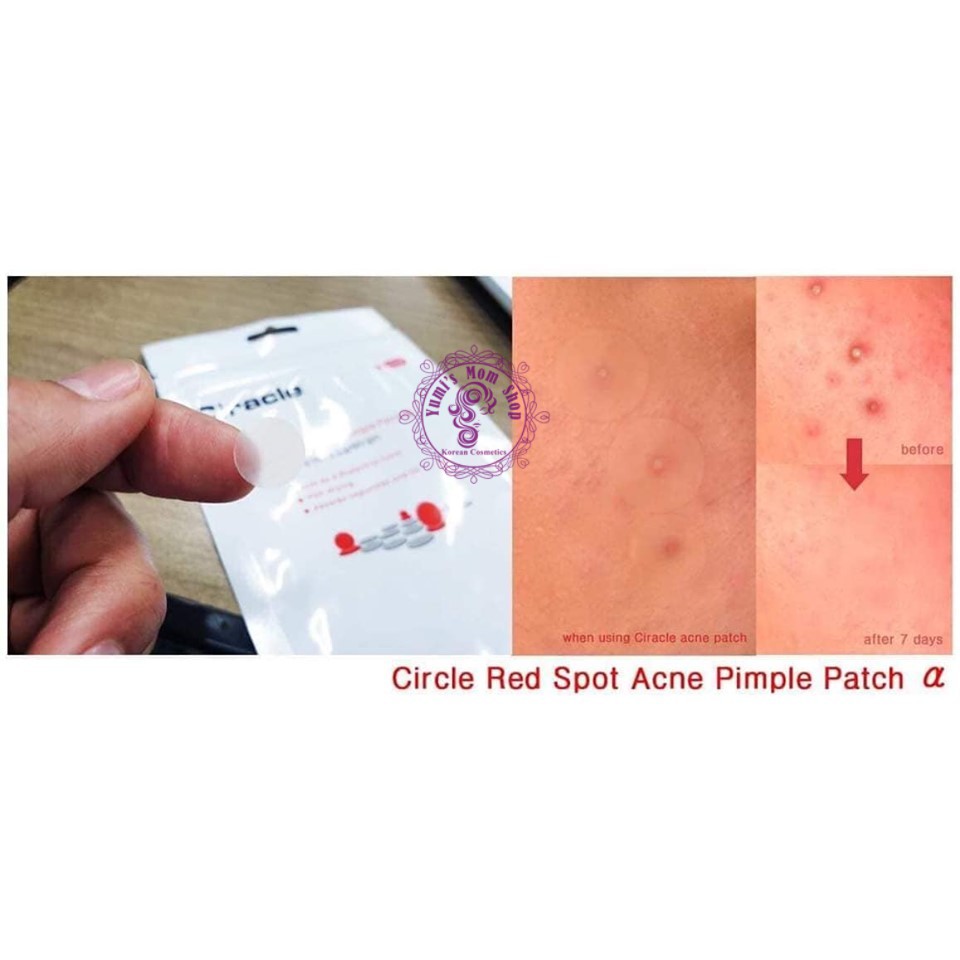 Miếng dán mụn Ciracle Red Spot Acne Pimple Patch | WebRaoVat - webraovat.net.vn
