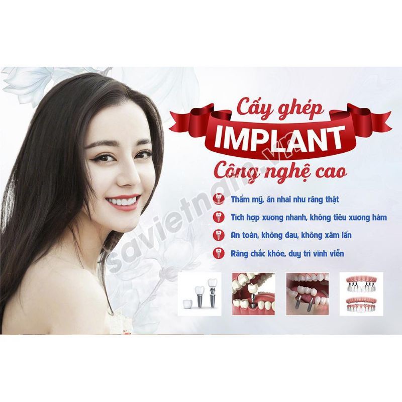 Tranh poster nha khoa tư vấn các chủ đề: răng sứ, implant, chỉnh nha, tẩy trắng,trám răng...