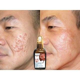 Set Serum Kem Xóa Sẹo Rỗ