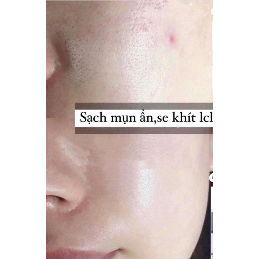 Tinh chất se lỗ chân lông PORE TREATMENT