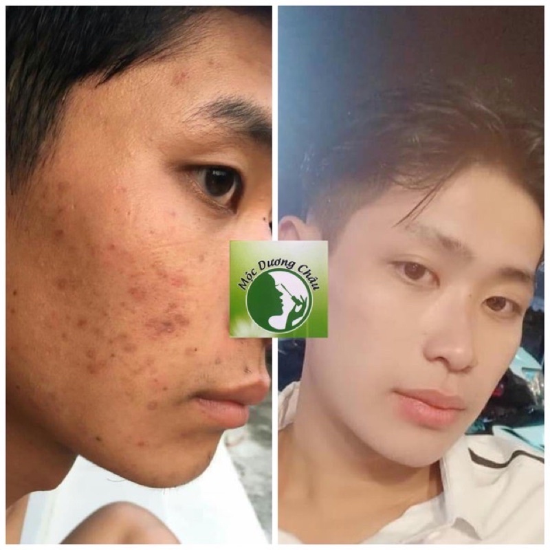 TÁI TẠO DA MỘC DƯƠNG CHÂU