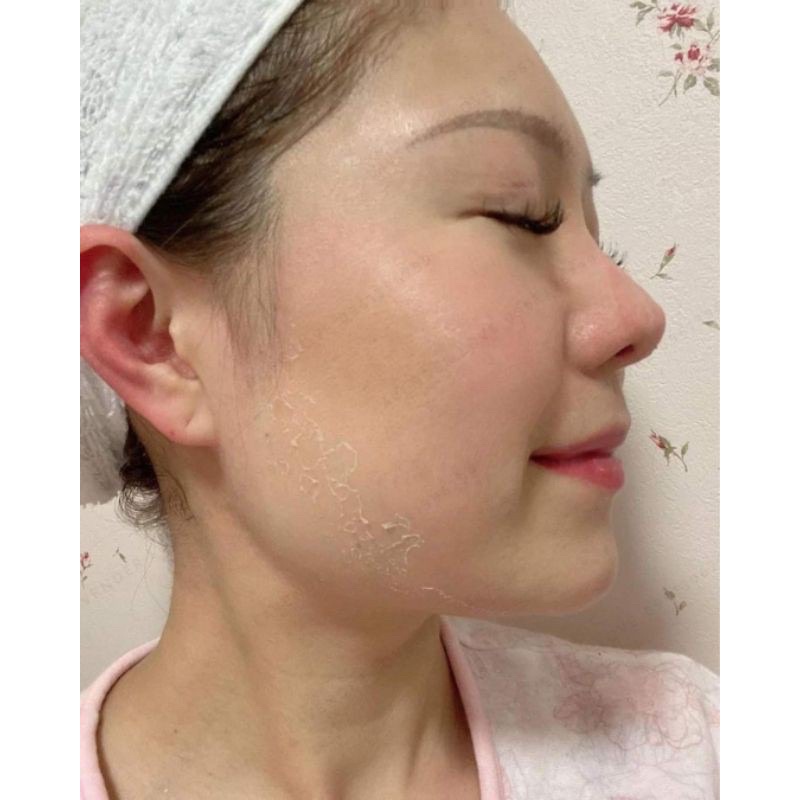 Date Mới Nhất 2025 -  Kem Loại nám tập trung - Pygmal Professional Peel Civasan