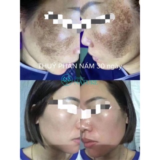 COMBO NÁM DOCTOR NATURE - (NGỪA NÁM NỘI TIẾT,NÁM MẢNG,NÁM NẶNG,TẮNG SẮC TỐ,CHÀM,..GIÚP DA KHỎE ĐẸP,CĂNG BÓNG).)