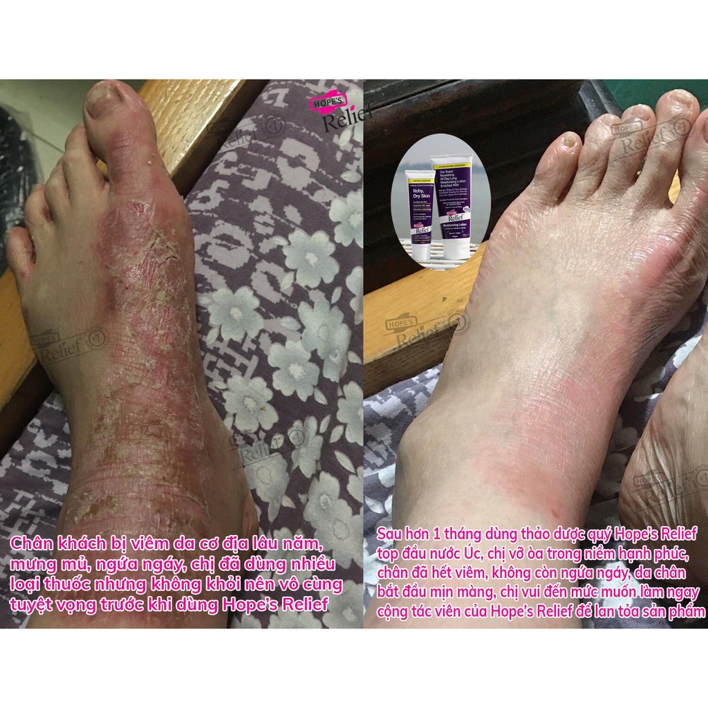 [Tặng Quà] Kem dưỡng da , dưỡng ẩm chống bong tróc, nứt nẻ  Hope’s Relief hỗ trợ eczema, viêm da, vảy nến (110g)