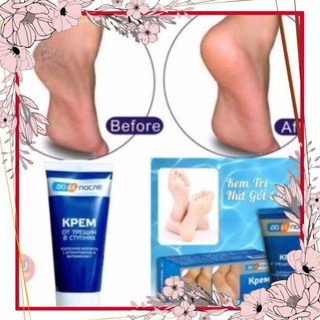 Kem nứt gót chân kpem nga tuýp 50ml