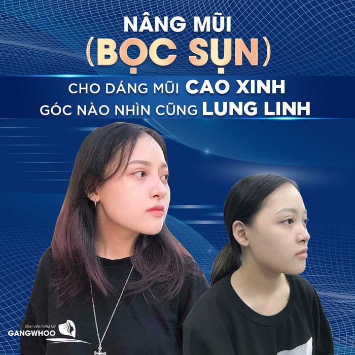 Dịch vụ nâng mũi bọc sụn tại Gangwhoo