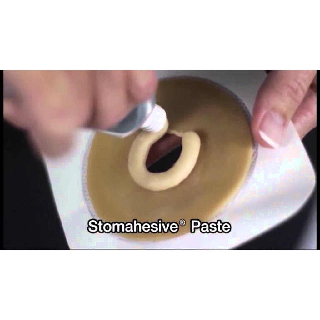 Keo chống xì cho hậu môn nhân tạo