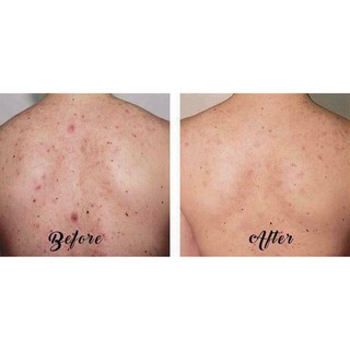 Bánh xà phòng giảm mụn lưng For back