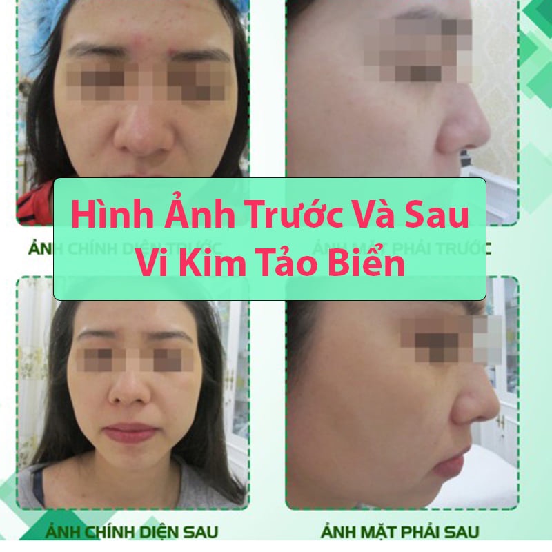 Siêu vi tảo, siêu vi kim, tảo nano tox peel dr pluscell (1 cặp)