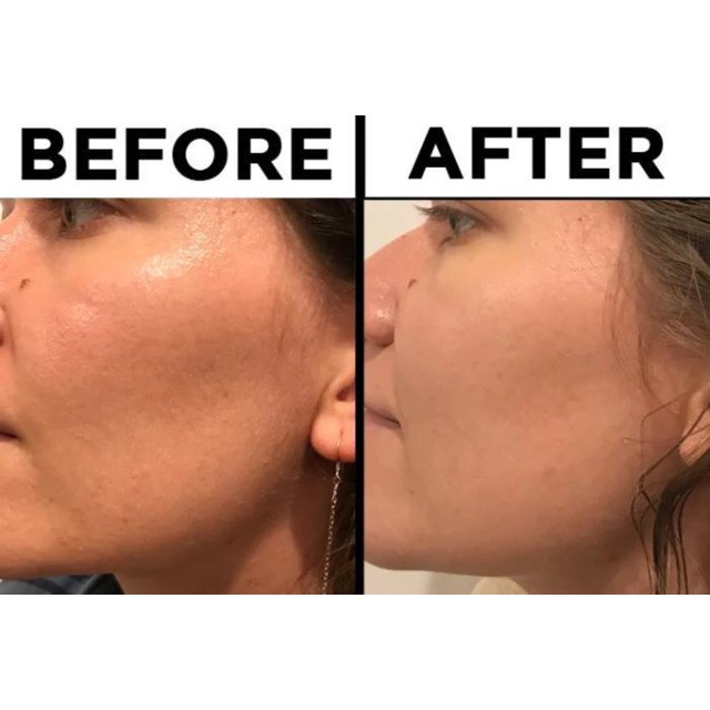 Tinh Chất The Ordinary Niacinamide 10% + Zinc 1% 30ml Ngừa Miụn &amp; Thâm