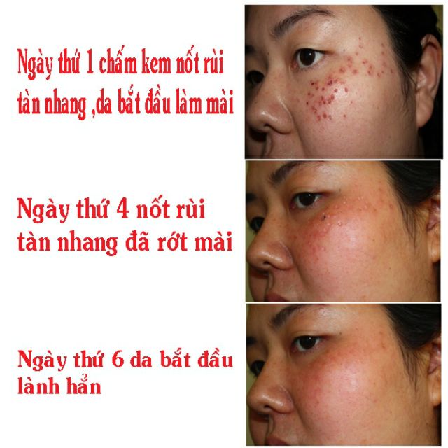 🌺Kem Xóa Nốt Ruồi