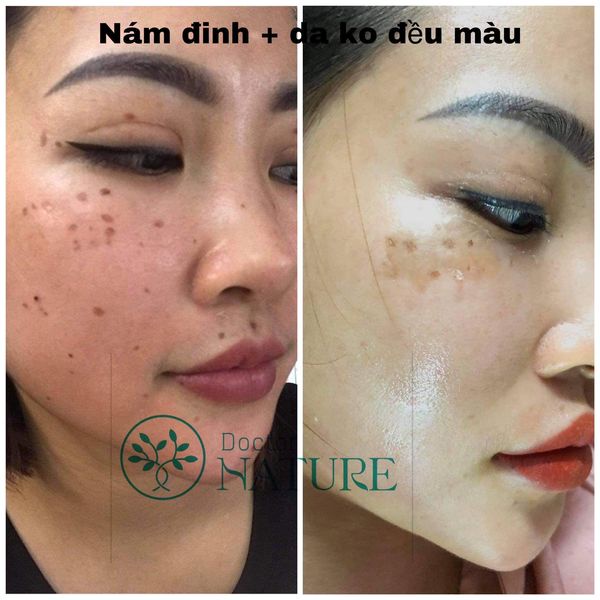 GEL HỦY NÁM DOCTOR NATURE