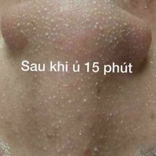 Ủ mụn cám, mụn đầu đen ( 30 ml )
