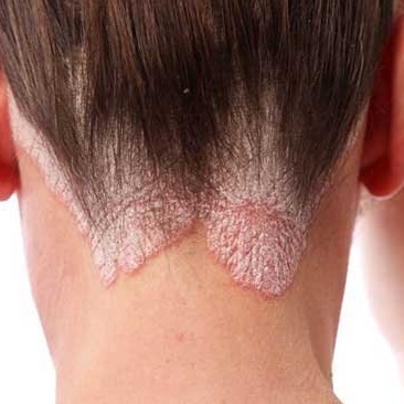 Kem bôi da liễu hỗ trợ Viêm da cơ địa, nấm ngứa, chàm, tổ đỉa,ghẻ nước,hắc lào ,lang ben, vảy nến | giảm ngứa nhanh | BigBuy360 - bigbuy360.vn