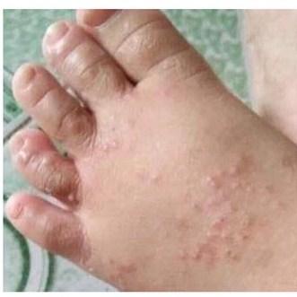 THẢO DƯỢC BÔI TỔ ĐỈA - GHẺ NƯỚC cho Trẻ Em SẢN PHẨM CÓ SẴN