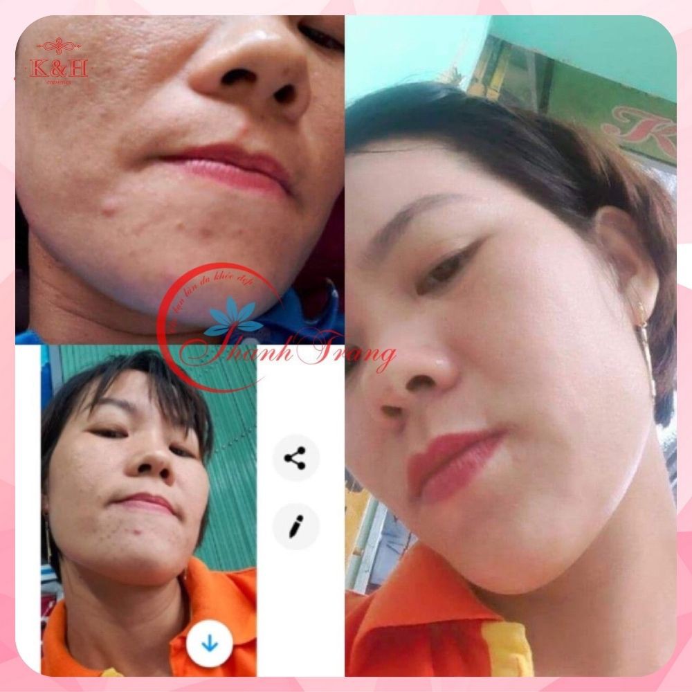 Thảo Dược Tái Tạo Da Trừ Mụn Thâm Nám Sẹo Rỗ Thanh Trang | BigBuy360 - bigbuy360.vn