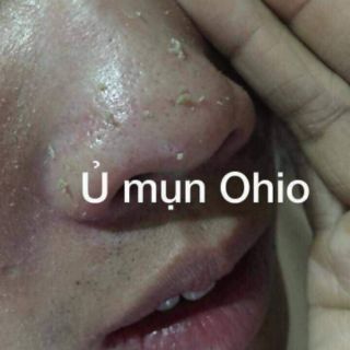 Ủ MỤN OHIO THẦN THÁNH
