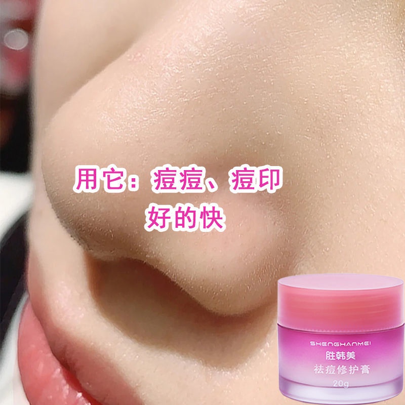 Kem Trị Mụn 20Gmaanshanzanzc.My11.27 Chuyên Dụng Chất Lượng | BigBuy360 - bigbuy360.vn