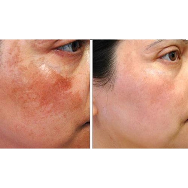 Cao Hỗ Trợ Da Nám, Tàn Nhang Detox White White Skin Melasma 35gr